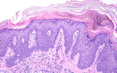 Nuevas opciones terapéuticas esperanzadoras para el tratamiento de la psoriasis