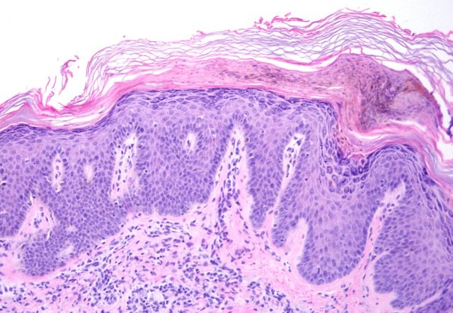 Piel transplantada en ratón con psoriasis. CNIO