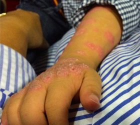 Psoriasis infantil: comprender la enfermedad mejora la calidad de vida