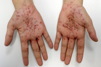 Acción Psoriasis, al lado de los pacientes en el Día Mundial de las Enfermedades Raras