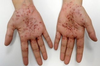 II Observatorio de la Psoriasis Pustulosa Generalizada